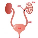 【腎臓結石】体験者の小杉が結石について調べてみた